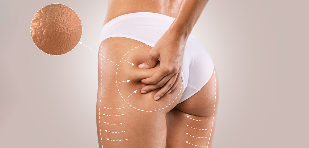 lipasa-combatir-celulitis