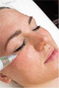 laser de plasma -blefaroplastia no ablativa