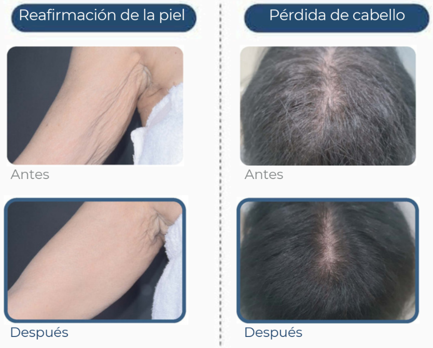 exosmart comparativa
